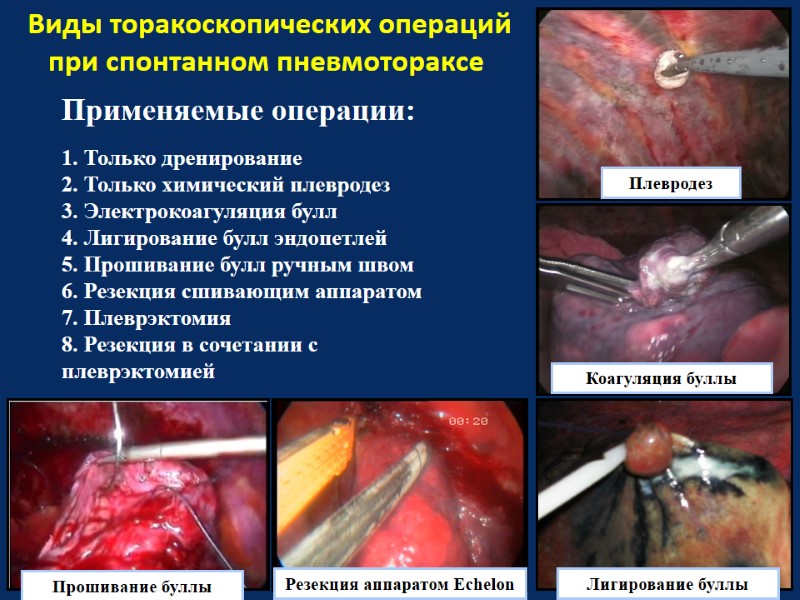 Виды торакоскопических операций при спонтанном пневмотораксе Применяемые операции:  1. Только дренирование  
